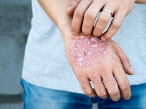 Managing Pustular Psoriasis: Insights and Support