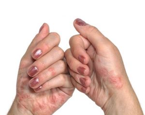 Decoding Psoriasis: Insights for Effective Management