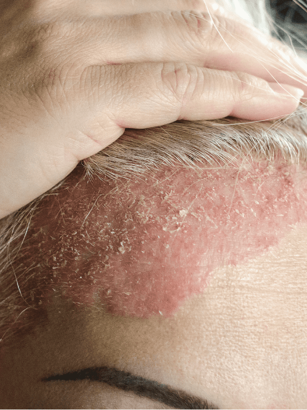 Psoriasis on Scalp Treatment in Surat