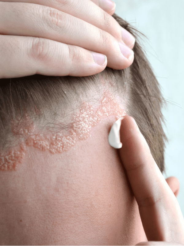 Scalp Psoriasis Treatment in Surat​