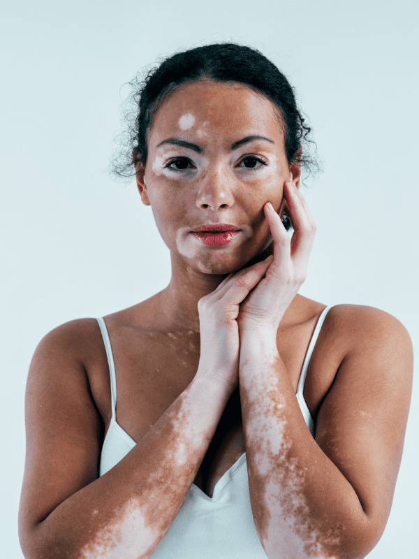 Vitiligo (Shwitra)