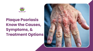 Plaque Psoriasis: Know the Causes, Symptoms, & Treatment Options