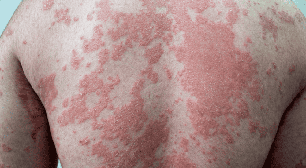 Know the Plaque Psoriasis Causes, Symptoms, & Treatment 