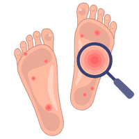 Feet psoriasis