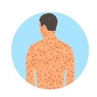 Guttate psoriasis