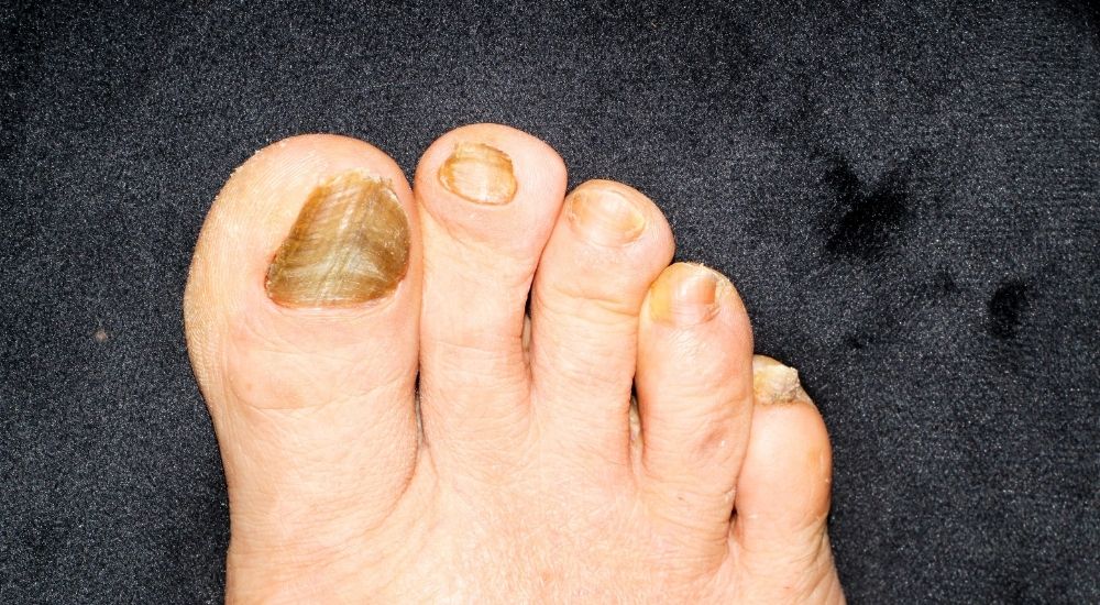 Nail Psoriasis vs. Fungus Differences, Symptoms, and Treatment