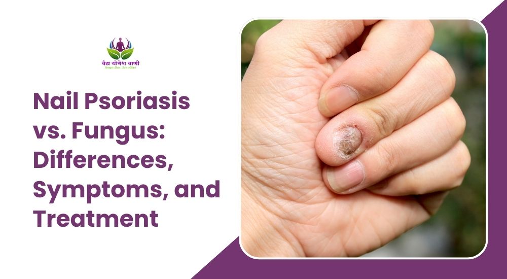 Nail Psoriasis vs. Fungus: Differences, Symptoms, and Treatment