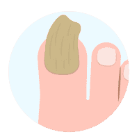 Nails psoriasis