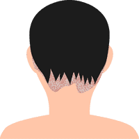 Scalp psoriasis