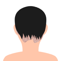 Scalp psoriasis