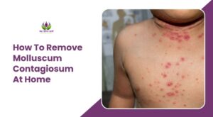 How to Get Rid Of Molluscum Contagiosum By Home Remedies