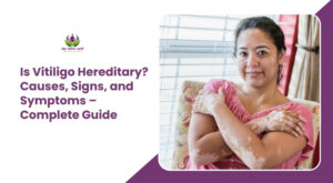 Is Vitiligo Hereditary? Causes, Signs, and Symptoms – Complete Guide