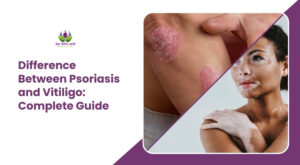 Difference Between Psoriasis and Vitiligo: Complete Guide