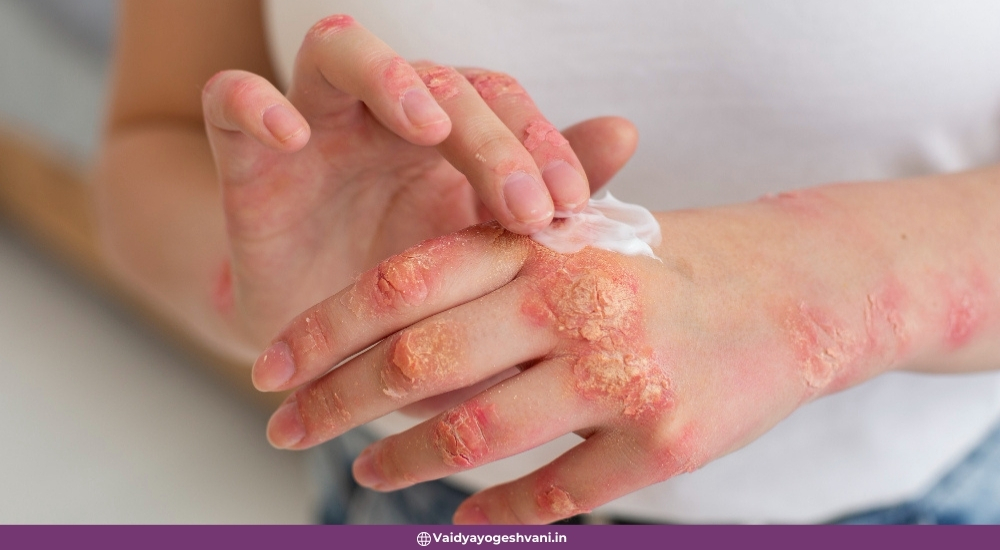 Adjusting Psoriasis Treatment for Seasonal Changes in Vadodara