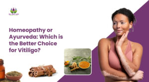 Homeopathy or Ayurveda: Which is the Better Choice for Vitiligo?