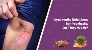 Ayurvedic Solutions for Psoriasis: Do They Work?