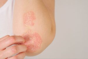 SECRETS OF PSORIASIS